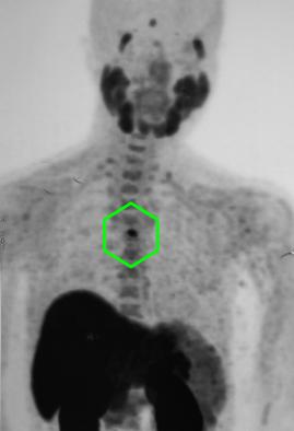Mediasten yerleşimli (Göğüs içi) paratiroid adenomu
