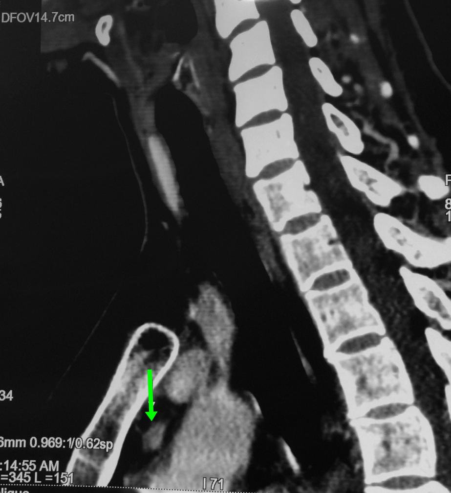 Mediasten yerleşimli (Göğüs içi) paratiroid adenomu