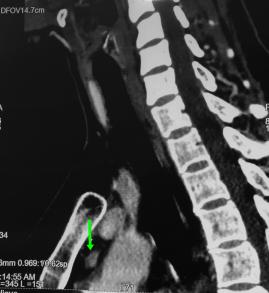 Mediasten yerleşimli (Göğüs içi) paratiroid adenomu